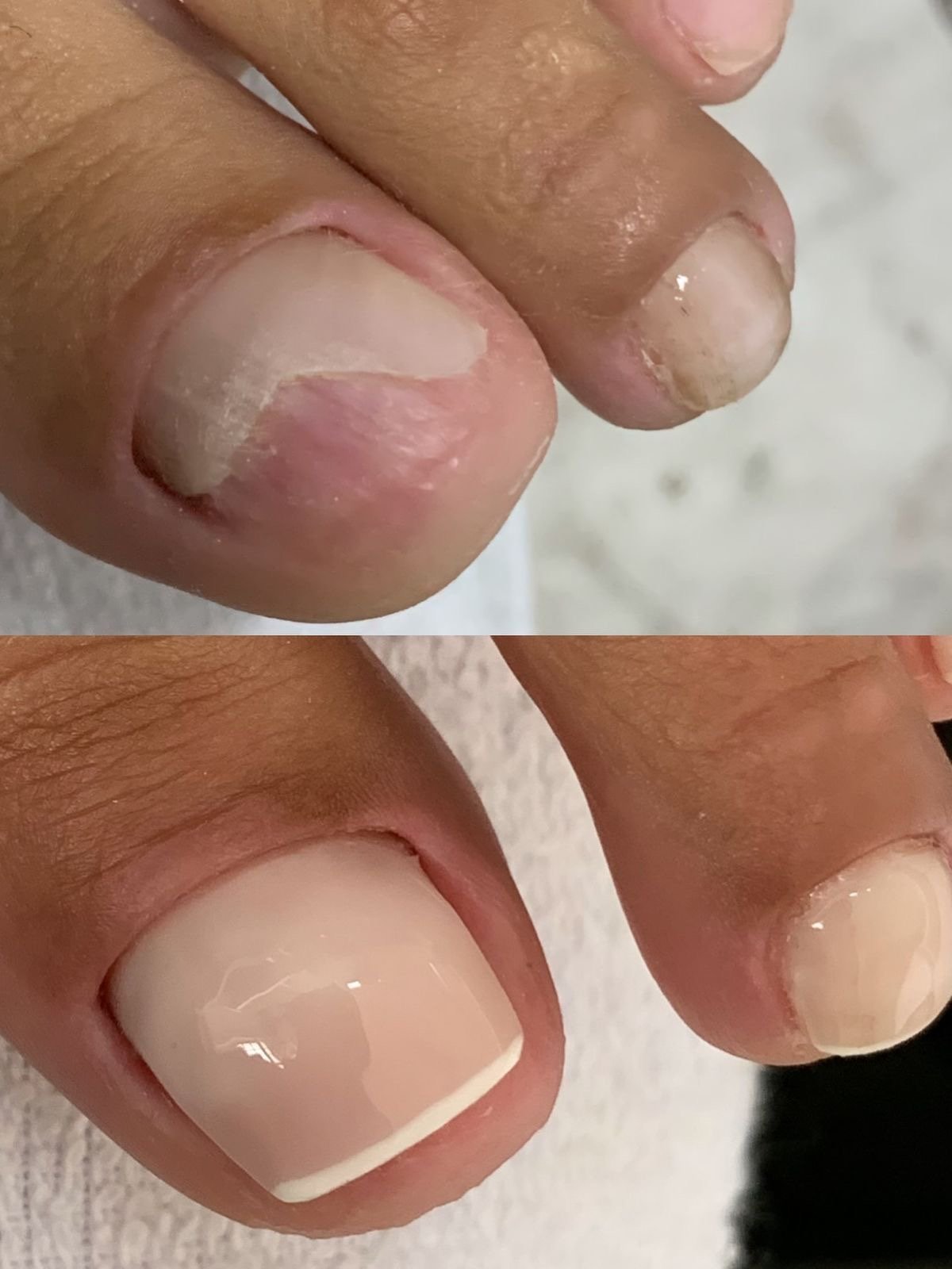 Reconstruction Acrygel (Gros Orteils)